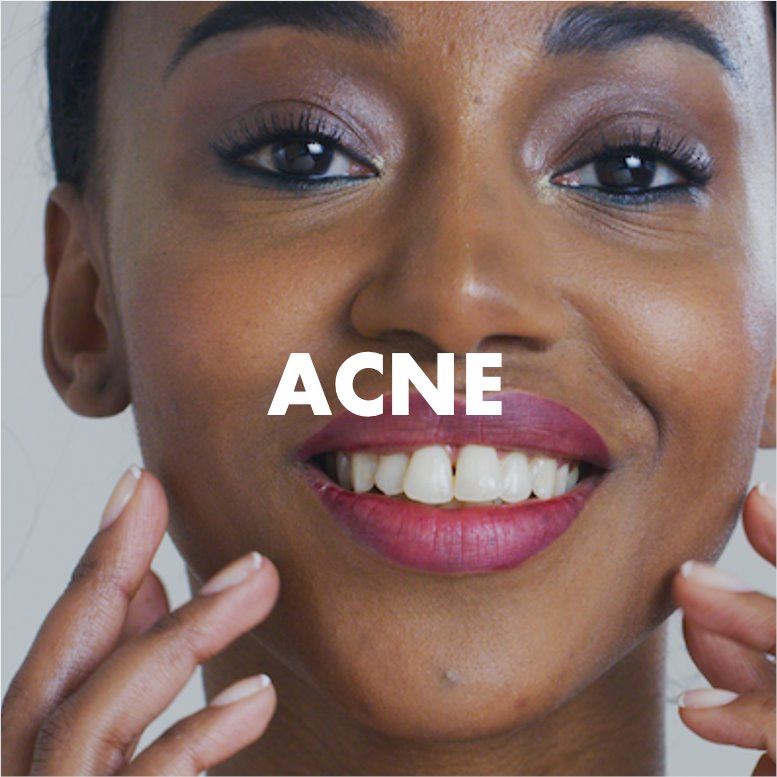 acne skin care natural