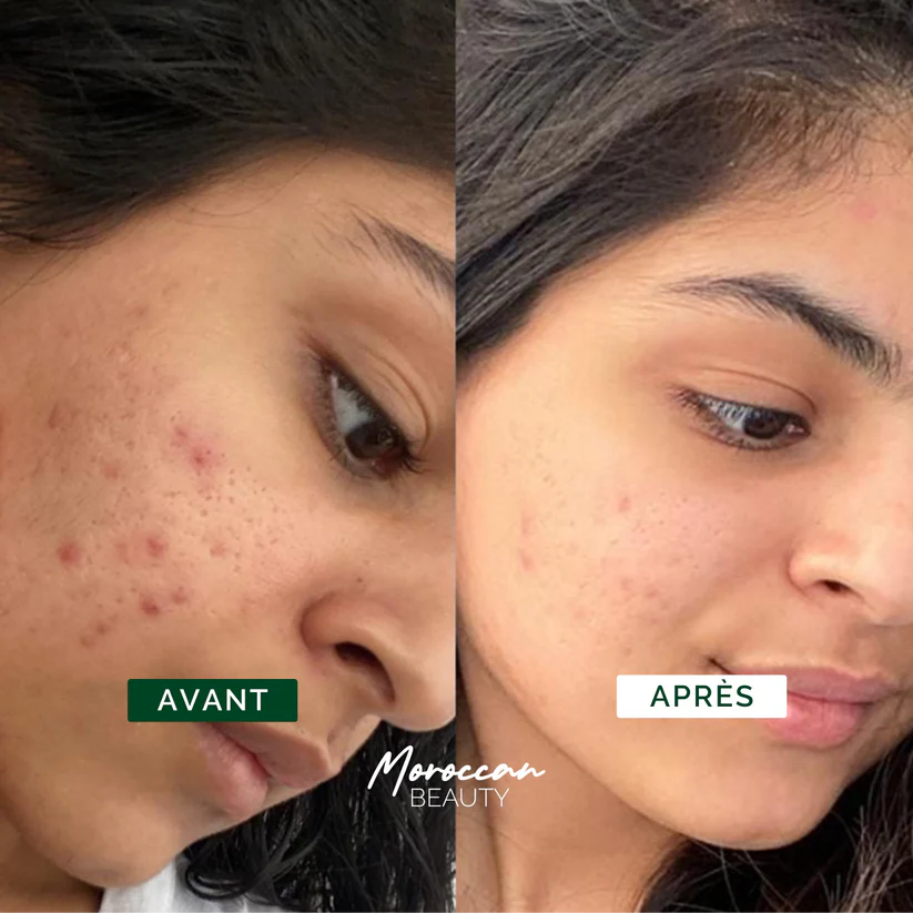 Nour Routine - Clear Skin